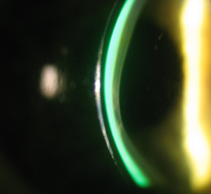 The Scleral Lense