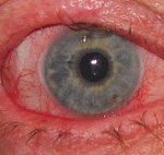 rccl0413-scleral1