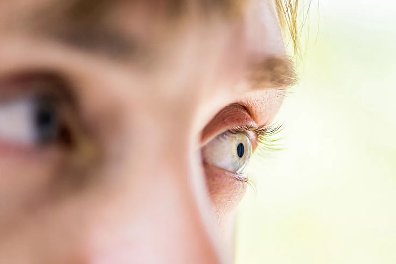 Symptoms of Keratoconus