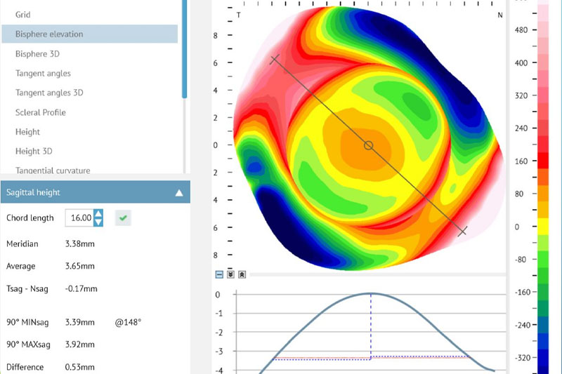 Diagnosing Keratoconus
